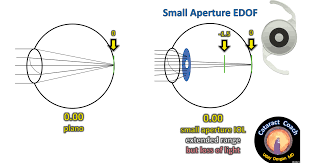 Extended depth of focus IOL